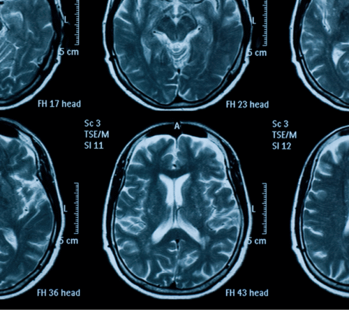 Obrazy rezonansu magnetycznego mózgu – przykładowa dokumentacja medyczna wykorzystywana w badaniu neurologopedycznym na potrzeby opinii biegłego sądowego.