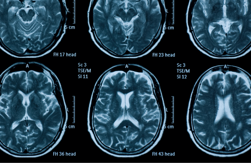 Obrazy rezonansu magnetycznego mózgu – przykładowa dokumentacja medyczna wykorzystywana w badaniu neurologopedycznym na potrzeby opinii biegłego sądowego.